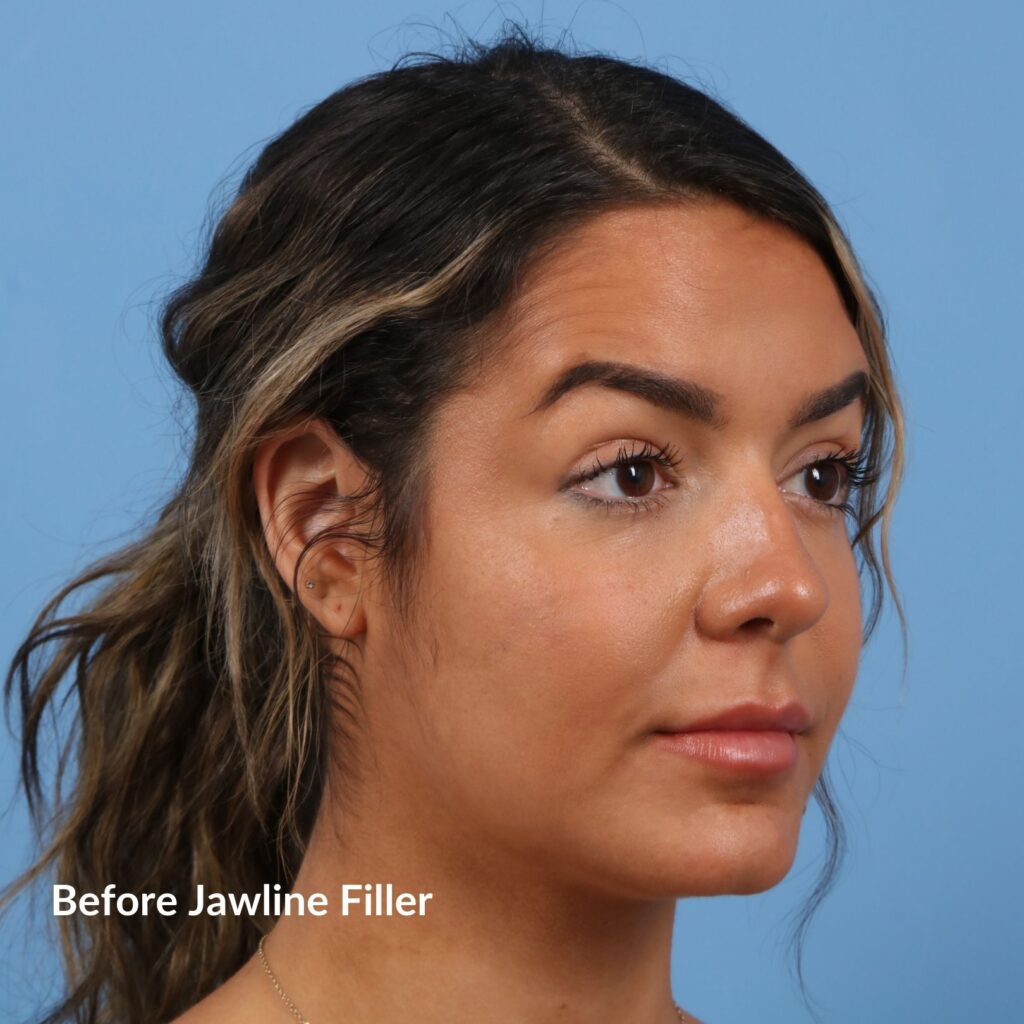 Jawline Filler Case #1690