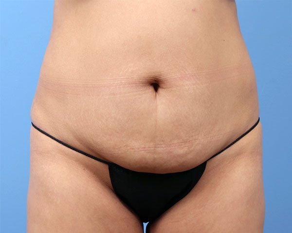 Tummy Tuck Case # 1590