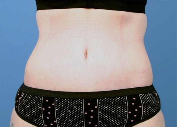 Tummy Tuck Case #1256