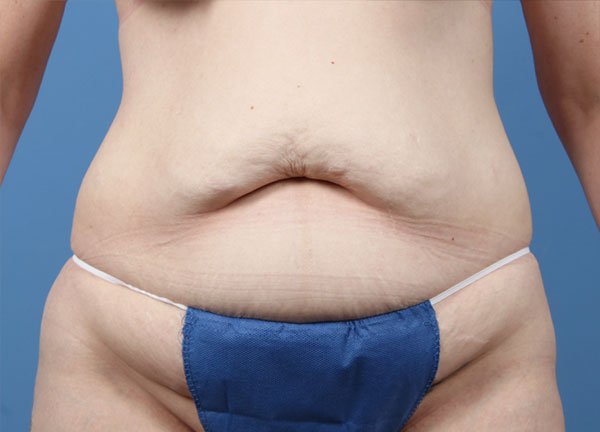 Tummy Tuck Case #1256