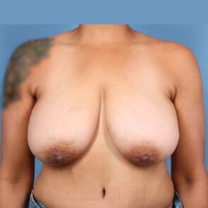 Breast lift Case #8661