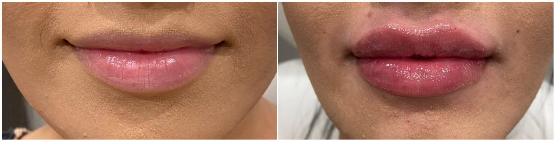 Before and after Restylane injection in the lips to treat lines and add volume 