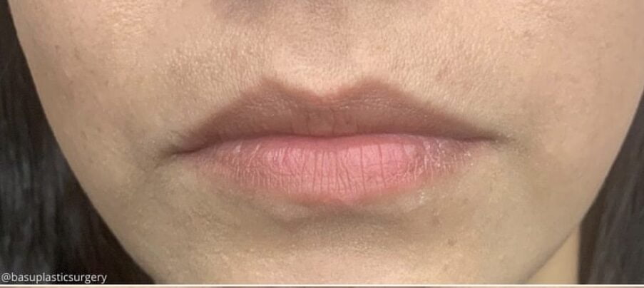 Lip Filler Case #258852