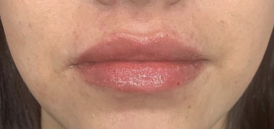 Lip Filler Case #258852