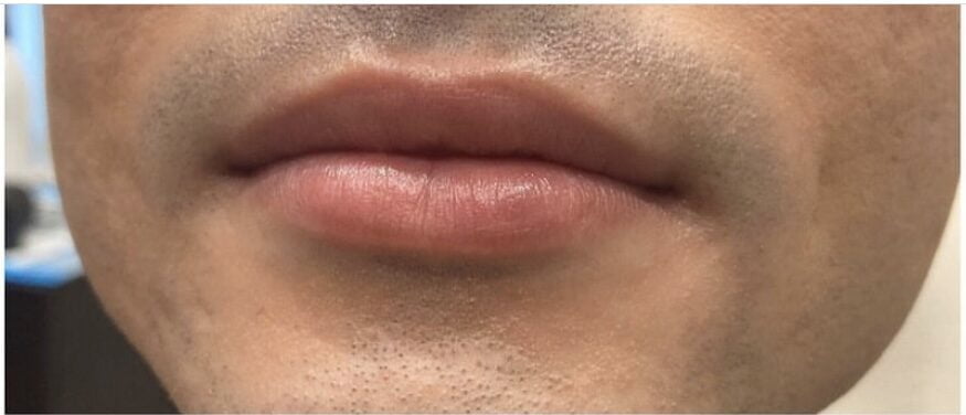 Lip Filler Case #258963