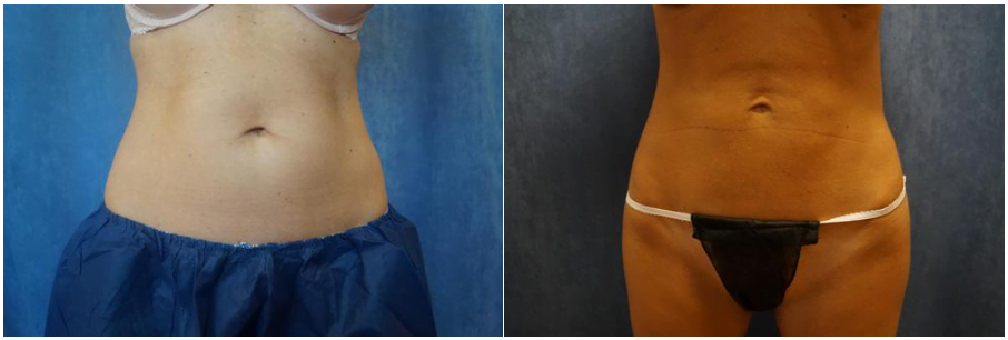 Front view of patient before and after CoolSculpting treatment