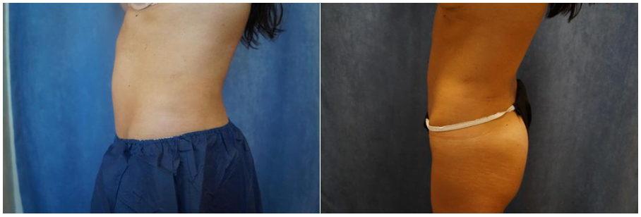 Side view of patient before and after CoolSculpting treatment