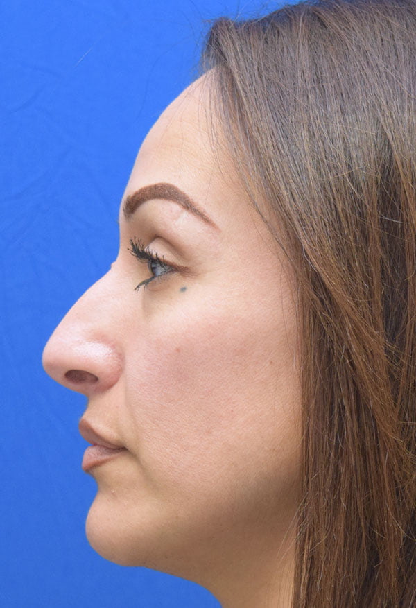 Rhinoplasty case 55555