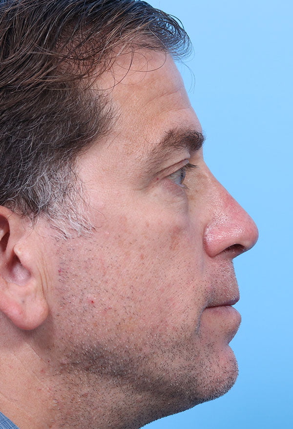 Rhinoplasty Male case 44445