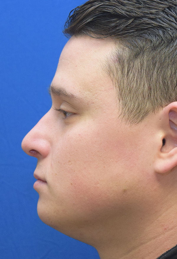 Rhinoplasty Male case 44444