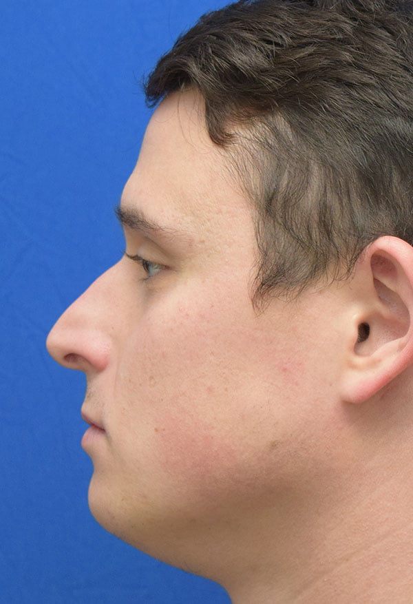 Rhinoplasty Male case 44444