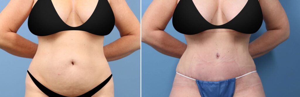 Tummy Tuck Houston, TX, Adominoplasty