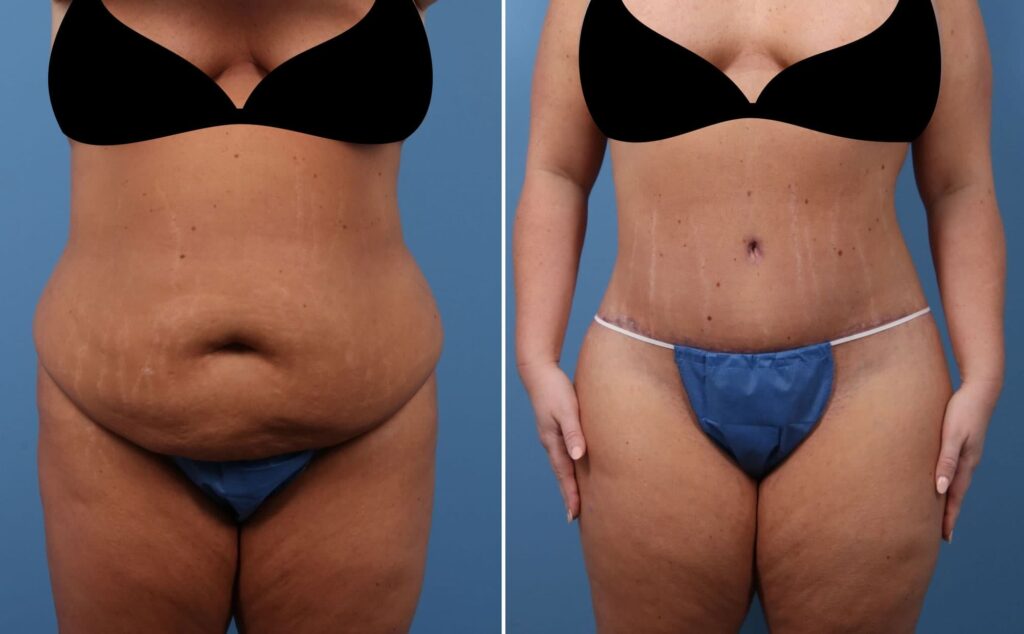 Reveal The Best Combined Treatment Of BBL Surgery & Abdominoplasty!