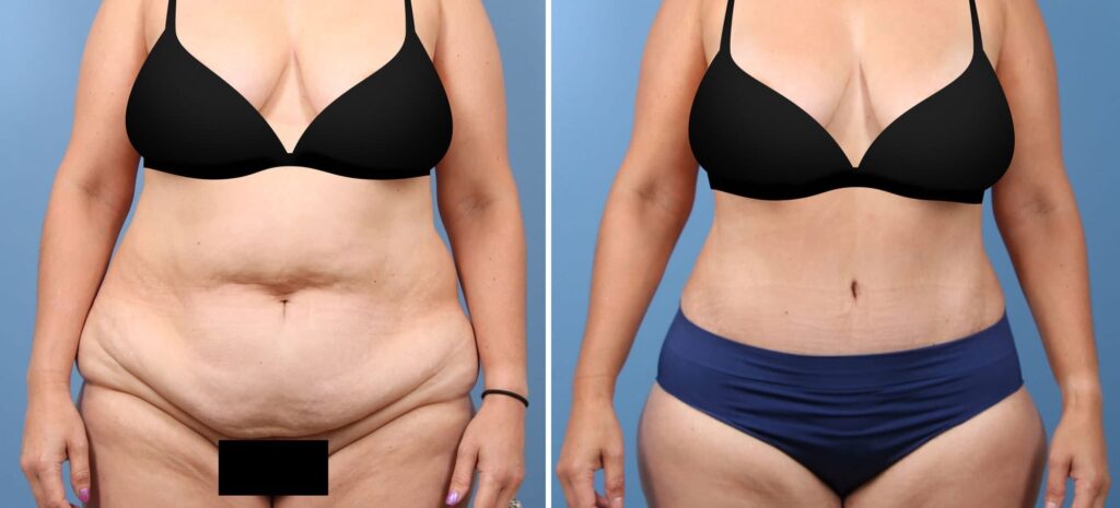 Before and after tummy tuck surgery with Houston plastic surgeon Dr. Bob Basu