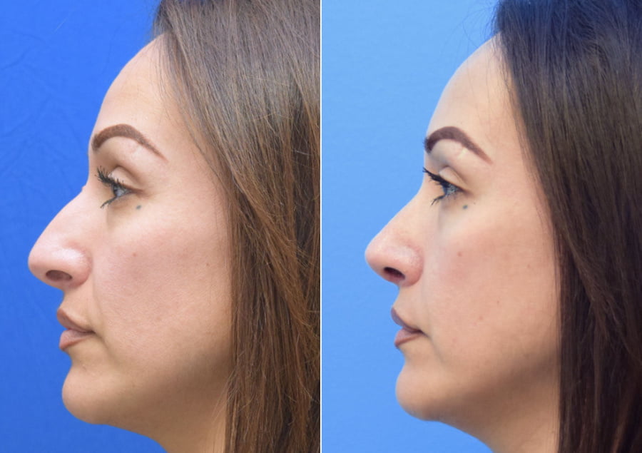 Before and after nose surgery with facial plastic surgeon Dr. Taylor DeBusk
