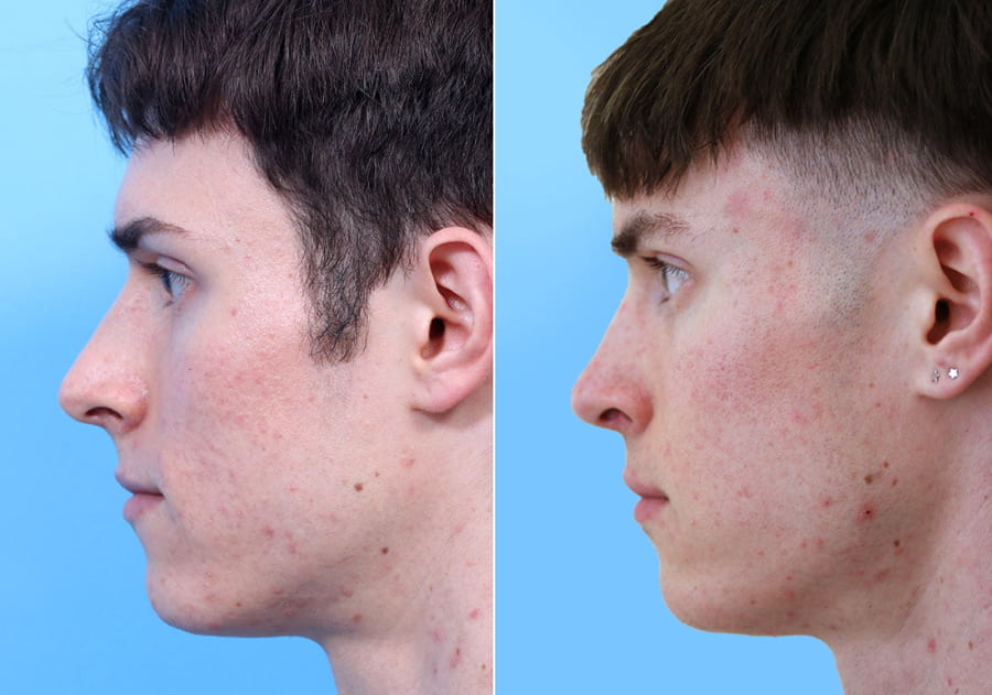 Young man shown before and after male rhinoplasty surgery with facial plastic surgeon Dr. DeBusk