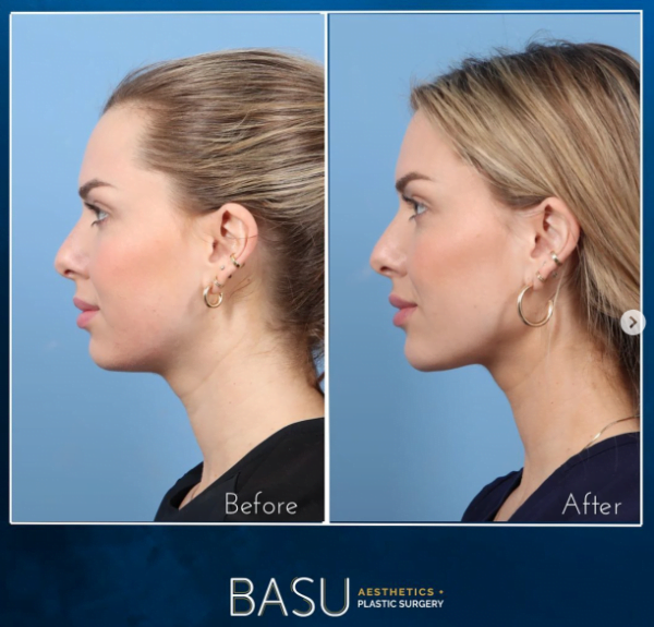 Before and after dermal filler treatment in the nose, lips, and chin