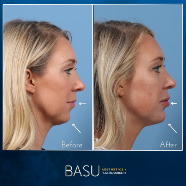 Before and after dermal filler facial rejuvenation at Houston medical spa