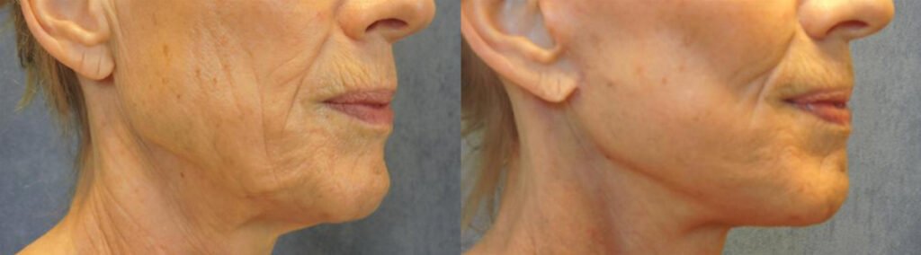 Real patient before and after facelift, neck lift, and trasnfer of subtle fat