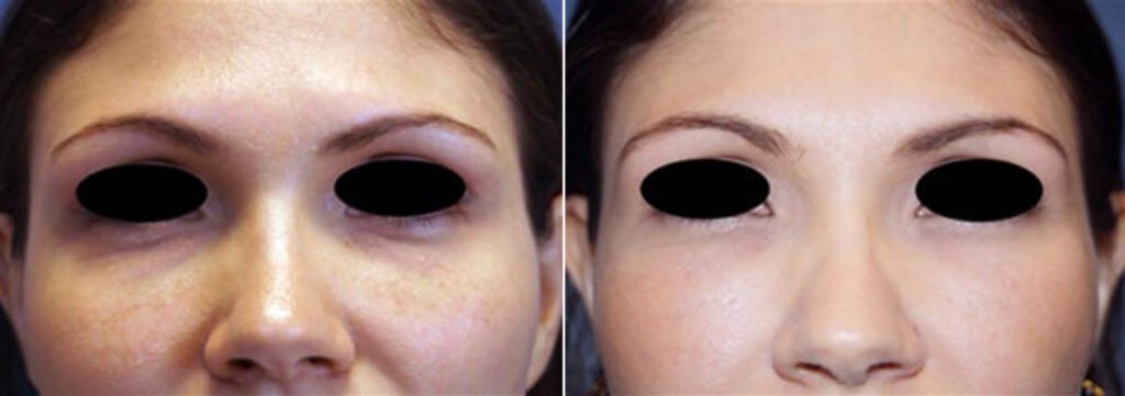 Before and after micrografting to improve under eyes with Dr. Basu in Houston