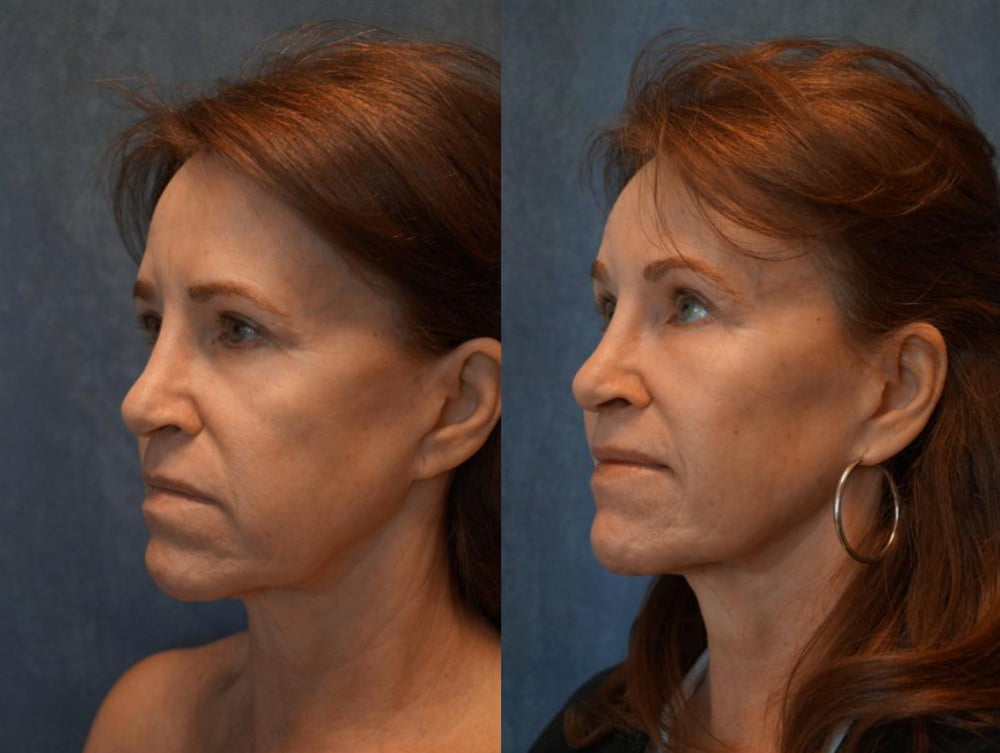 Real patient before and after fat transfer to the face with Houston plastic surgeon Dr. Bob Basu