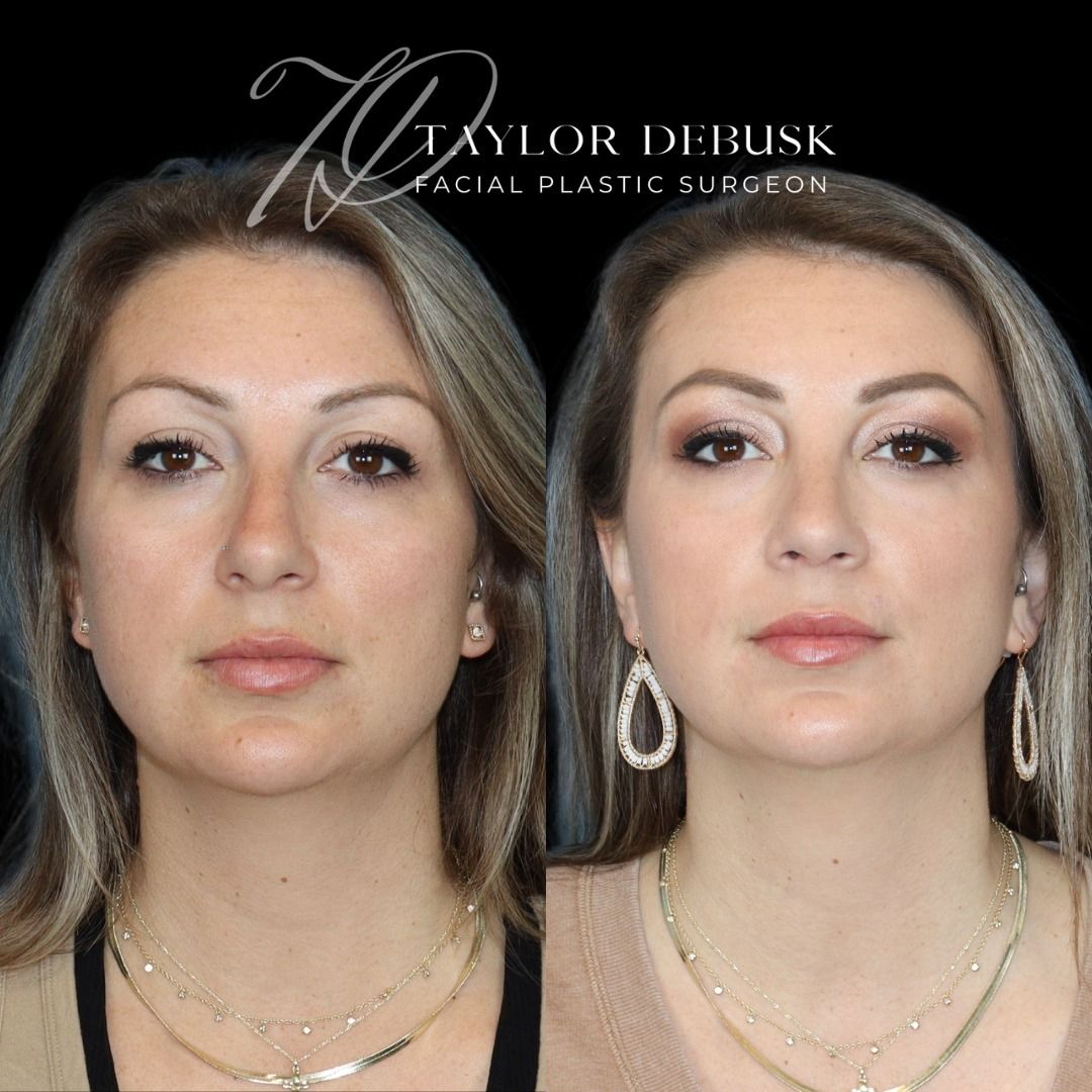 Before and after photo of the front view of rhinoplasty results for addressing a nasal hump and bulbous tip. 