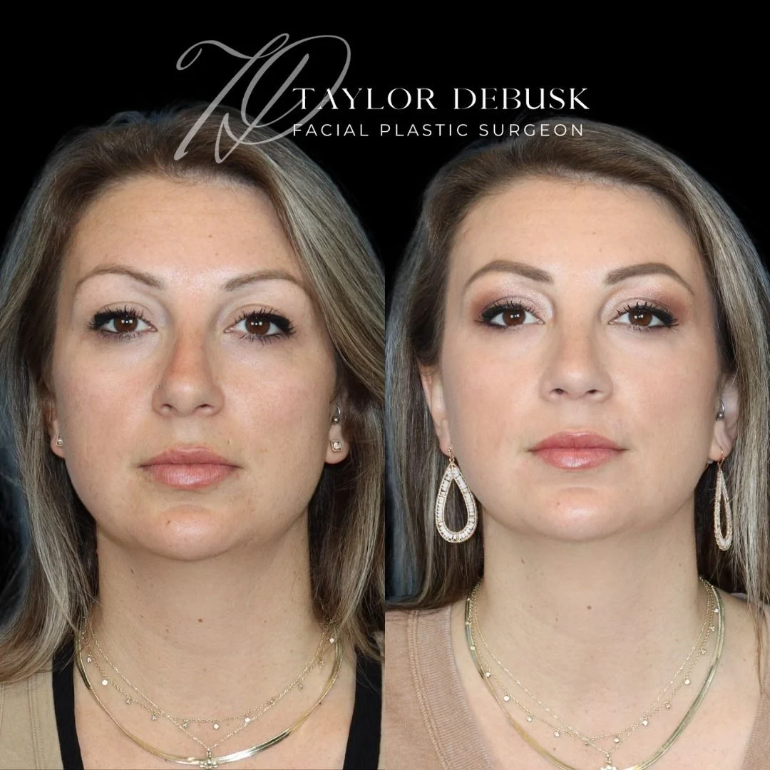 Before and after photo of the front view of rhinoplasty results for addressing a nasal hump and bulbous tip.