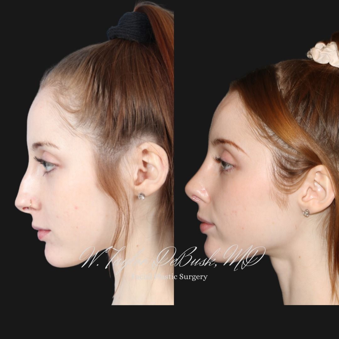 Before and after photo of the front view of rhinoplasty results for addressing a bump on the nose bridge and a bulbous tip. 