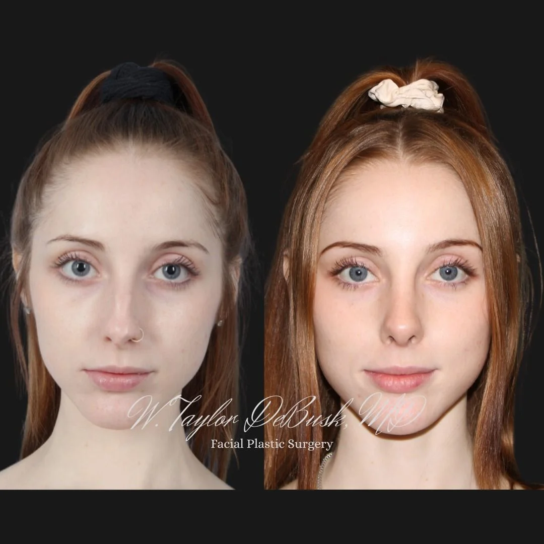 Before and after photo of the front view of rhinoplasty results for addressing a bump on the nose bridge and a bulbous tip.
