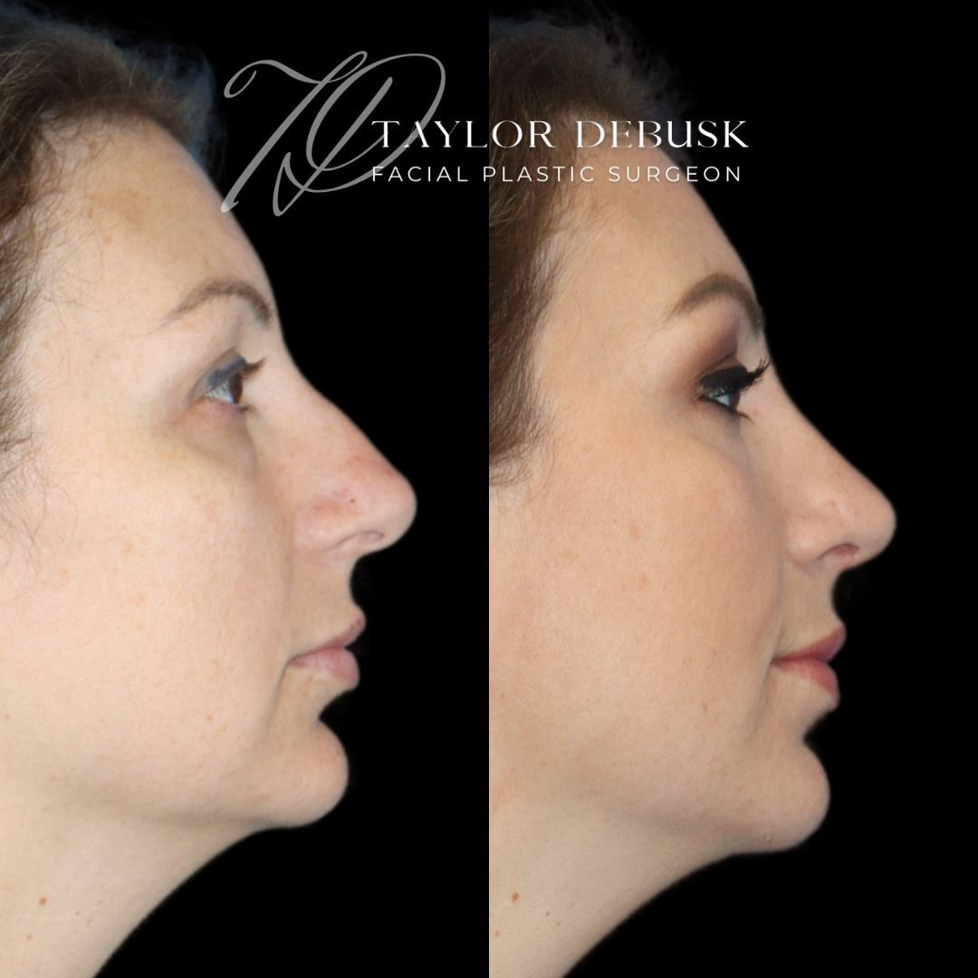 Before and after photo of the front view of rhinoplasty results for addressing a nasal hump and bulbous tip. 