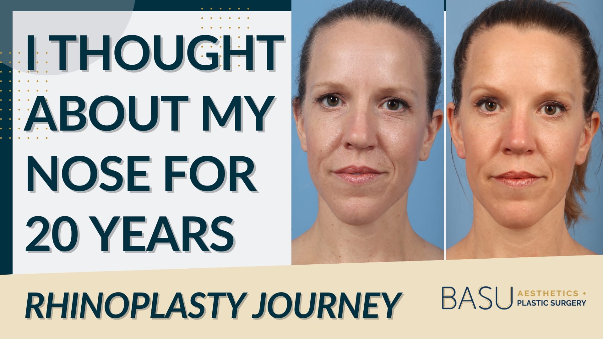 [I Thought About My Nose for 20 Years - Rhinoplasty Journey] Houston facial plastic surgeon Dr. Taylor DeBusk's patient Andrea before (left) vs. after (right) rhinoplasty