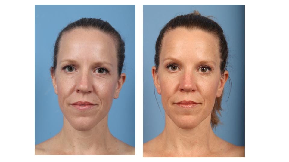 Andrea's front facial profile before (left) vs. after (right) rhinoplasty with Dr. Taylor DeBusk