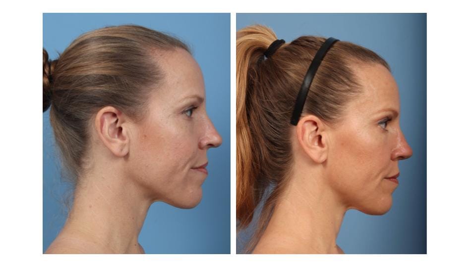 Andrea's side facial profile before (left) vs. after (right) rhinoplasty with Dr. Taylor DeBusk