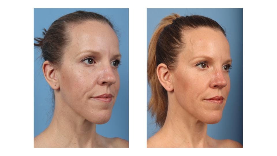 Andrea's oblique profile before (left) vs. after (right) rhinoplasty with Dr. Taylor DeBusk